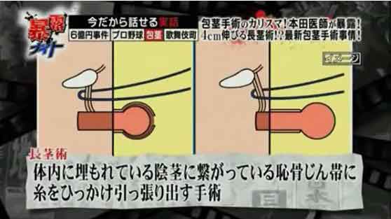 切らない包茎手術の口コミ評判は？専門クリニックで聞いてきました